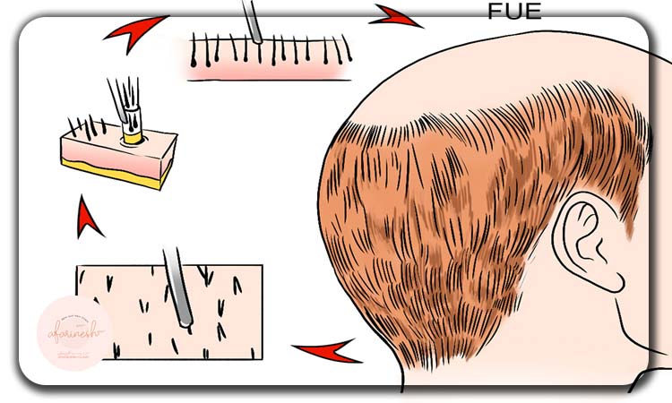 هزینه کاشت مو به‌صرفه تر است یا ترمیم مو؟