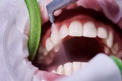 جرم‌گیری، راهی موثر برای پیشگیری از پوسیدگی و بیماری لثه